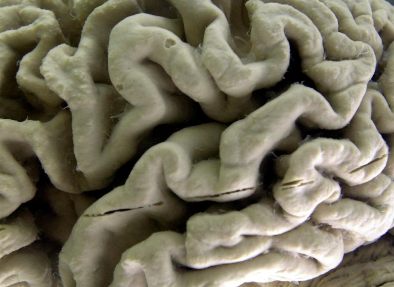 Silent brain changes precede Alzheimer’s. Researchers have new clues about which...